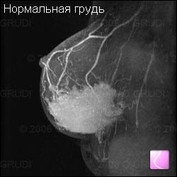 Не есть мясо и не пить молоко. Есть ли возможность спастись от рака груди?