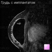 Не есть мясо и не пить молоко. Есть ли возможность спастись от рака груди?