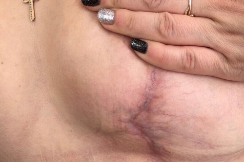 «Я ему доверяла!» Жительнице Магнитогорска изуродовали грудь в частной клинике